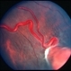 Retinal Hemangioblastoma